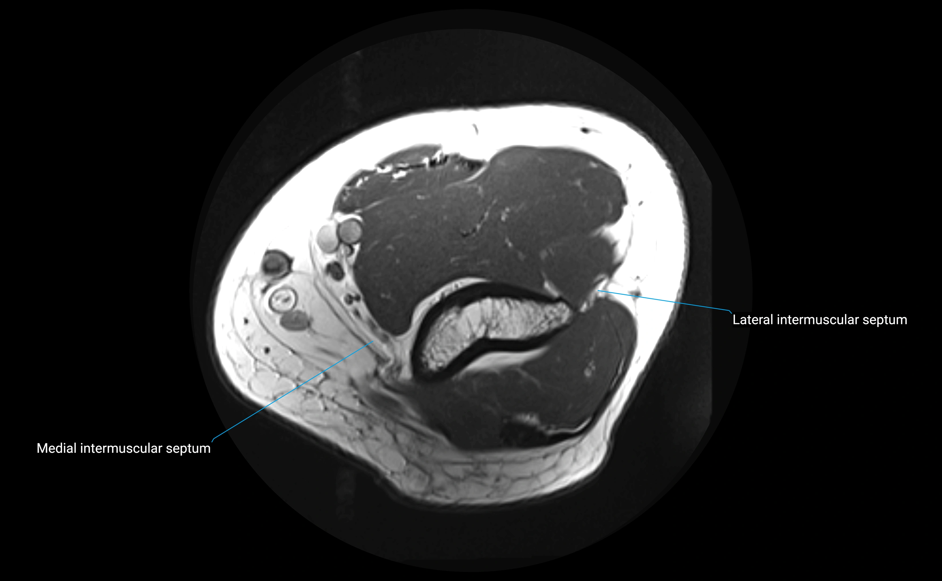 MRI elbow ligaments axial cross sectional anatomy 3T  radiology  image-img-00001-00006.webp